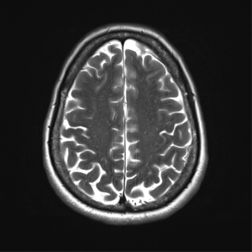 File:Anaplastic astrocytoma - thalamic glioma (Radiopaedia 59709-67115 Axial T2 28).png