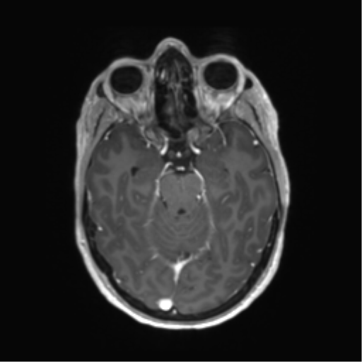 File:Anaplastic astrocytoma IDH mutant (Radiopaedia 50046-55341 Axial T1 C+ 19).png