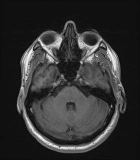 Anaplastic astrocytoma IDH wild-type (Radiopaedia 49984-55273 Axial T1 17).png