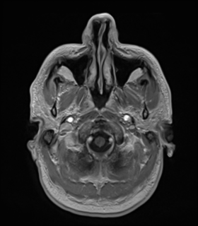 File:Anaplastic astrocytoma IDH wild-type (Radiopaedia 49984-55273 Axial T1 C+ 7).png