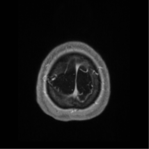 Anaplastic astrocytoma IDH wild-type (pseudoprogression) (Radiopaedia 42209-45276 Axial T1 C+ 139).png