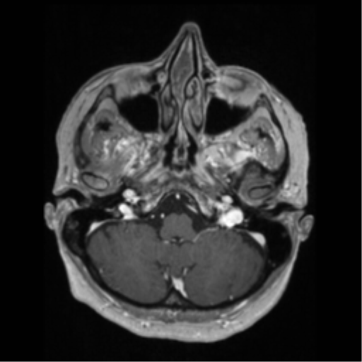 File:Anaplastic astrocytoma IDH wild-type (pseudoprogression) (Radiopaedia 42209-45276 Axial T1 C+ 33).png