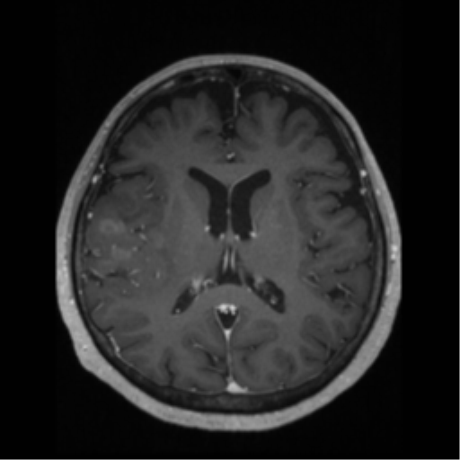 File:Anaplastic astrocytoma IDH wild-type (pseudoprogression) (Radiopaedia 42209-45276 Axial T1 C+ 86).png