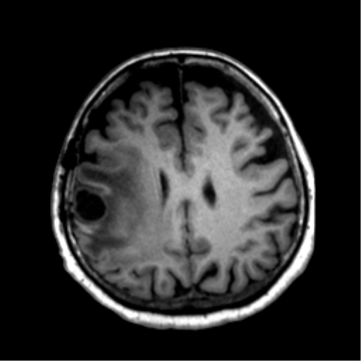 Anaplastic astrocytoma IDH wild-type (pseudoprogression) (Radiopaedia 42209-45277 Axial T1 89).png