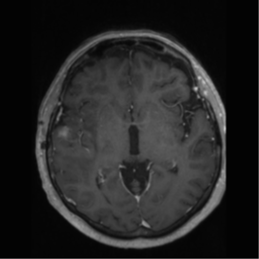 File:Anaplastic astrocytoma IDH wild-type (pseudoprogression) (Radiopaedia 42209-45277 Axial T1 C+ 58).png