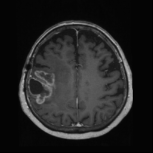 File:Anaplastic astrocytoma IDH wild-type (pseudoprogression) (Radiopaedia 42209-45278 Axial T1 C+ 106).png