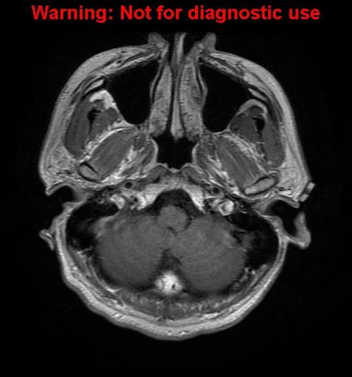 File:Anaplastic ganglioglioma (Radiopaedia 44921-48831 Axial T1 C+ 4).jpg