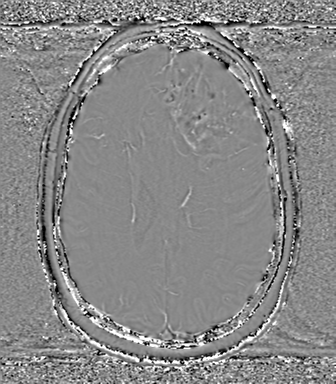Anaplastic oligodendroglioma (Radiopaedia 83500-98599 Axial SWI - phase 55).png