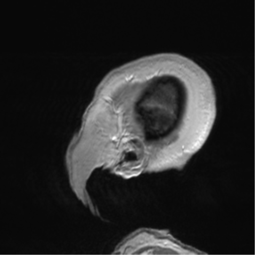 Anaplastic oligodendroglioma (Radiopaedia 83500-98599 Sagittal T1 C+ 59).png