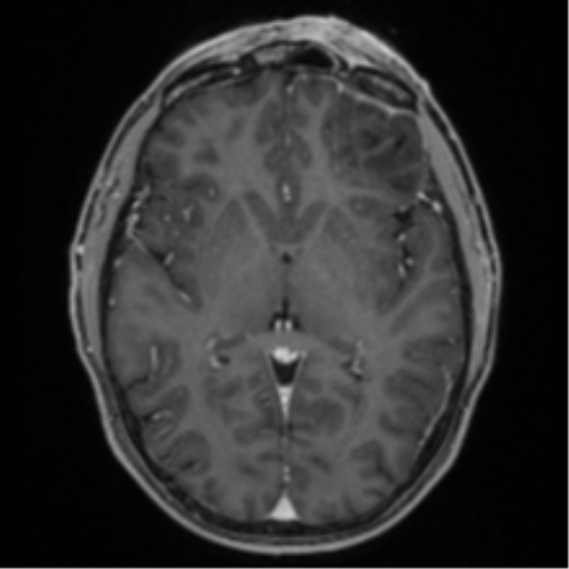 Anaplastic oligodendroglioma with skull fracture (Radiopaedia 74831-85845 Axial T1 C+ fat sat 31).png