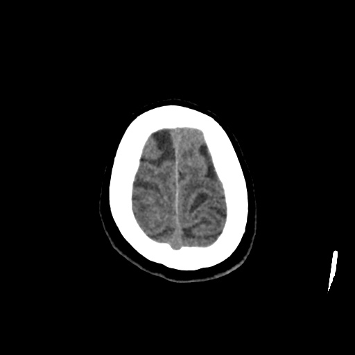 Aneursym related subarachnoid hemorrhage with hydrocephalus (Radiopaedia 45105-49083 Axial non-contrast 46).jpg