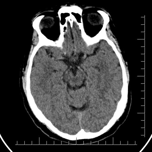 Aneurysm of posterior communicating artery (Radiopaedia 20188-20162 Axial non-contrast 18).jpg