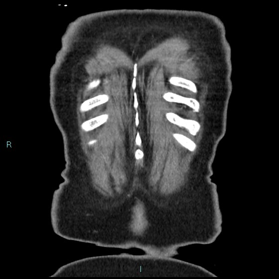 File:Aneurysm of the inferior vena cava (Radiopaedia 65330-74361 C 97).jpg