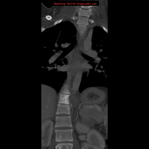 File:Aneurysmal bone cyst (Radiopaedia 9419-10102 Coronal bone window 4).jpg