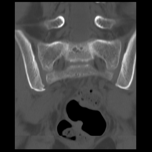 File:Aneurysmal bone cyst - sacrum (Radiopaedia 65190-74195 Coronal bone window 3).jpg