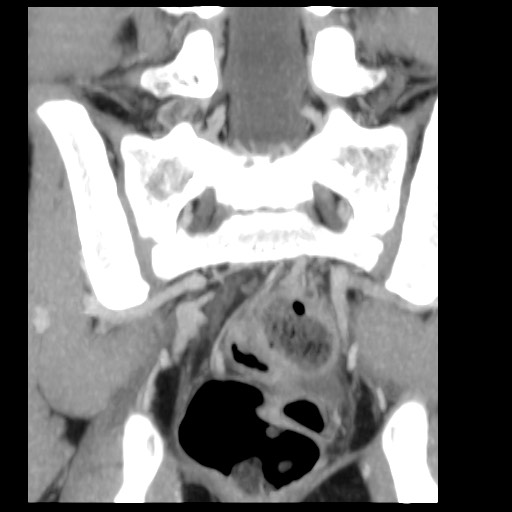 File:Aneurysmal bone cyst - sacrum (Radiopaedia 65190-74195 D 5).jpg