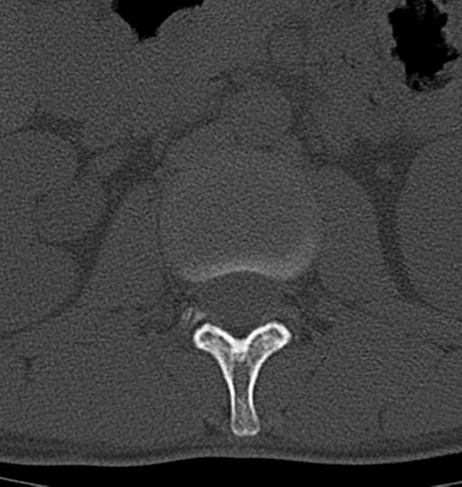 Aneurysmal bone cyst T11 (Radiopaedia 29294-29721 Axial bone window 70).jpg