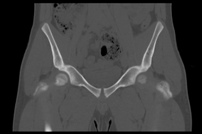 File:Aneurysmal bone cyst of ischium (Radiopaedia 25957-26094 Coronal bone window 13).png