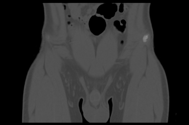 File:Aneurysmal bone cyst of ischium (Radiopaedia 25957-26094 Coronal bone window 2).png