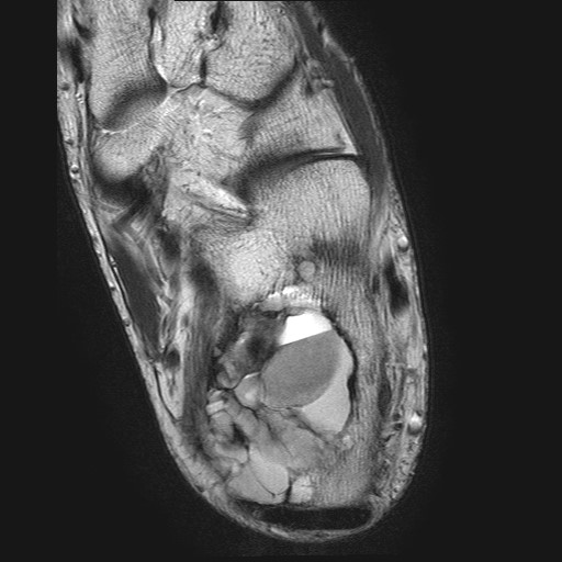 File:Aneurysmal bone cyst of the calcaneus (Radiopaedia 60669-68420 Axial T2 12).jpg