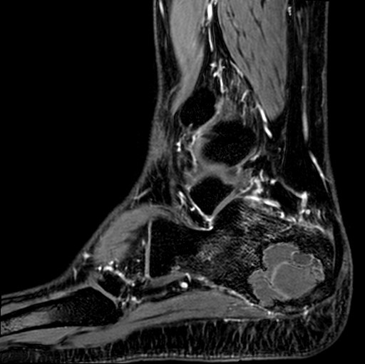 File:Aneurysmal bone cyst of the calcaneus (Radiopaedia 60669-68420 F 8).jpg