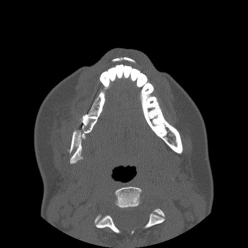 File:Aneurysmal bone cyst of the mandible (Radiopaedia 43280-46823 Axial bone window 52).jpg