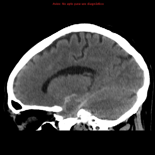 File:Aneurysmal subarachnoid hemorrhage (Radiopaedia 24740-24997 non-contrast 32).jpg