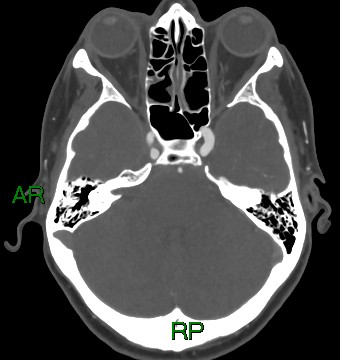 File:Aneurysmal subarachnoid hemorrhage with intra-axial extension (Radiopaedia 84371-99732 A 37).jpg