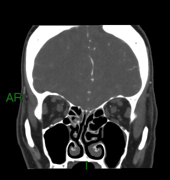 Aneurysmal subarachnoid hemorrhage with intra-axial extension (Radiopaedia 84371-99732 C 76).jpg