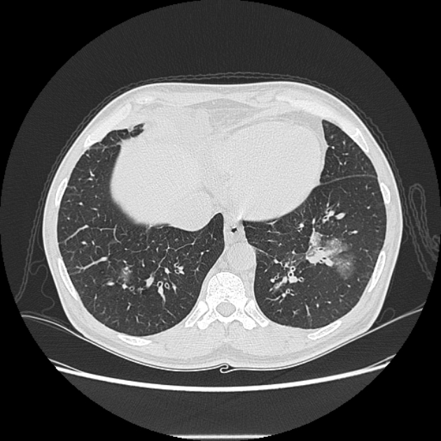 Angioinvasive aspergellosis (Radiopaedia 66995-76315 Axial lung window 40).jpg