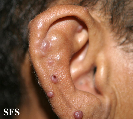 Angiolymphoid Hyperplasia With Eosinophilia (Dermatology Atlas 8).jpg