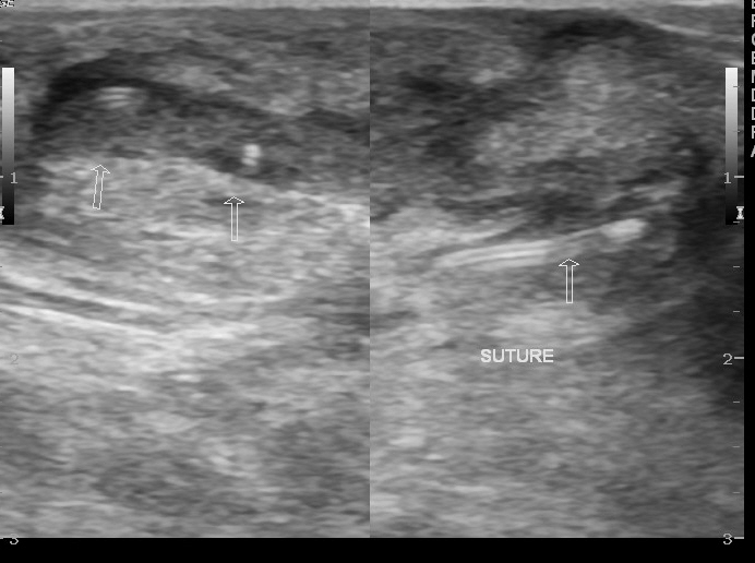 File:Ankle sinus (Radiopaedia 12913-13017 D 1).jpg