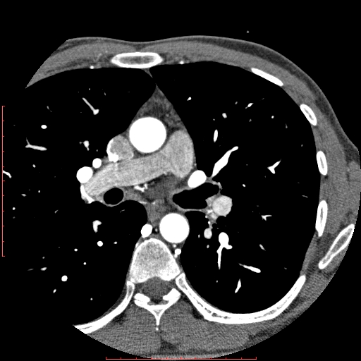 Anomalous left coronary artery from the pulmonary artery (ALCAPA) (Radiopaedia 70148-80181 A 1).jpg