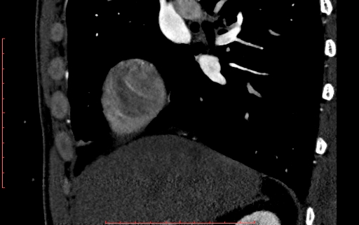 File:Anomalous left coronary artery from the pulmonary artery (ALCAPA) (Radiopaedia 70148-80181 C 13).jpg