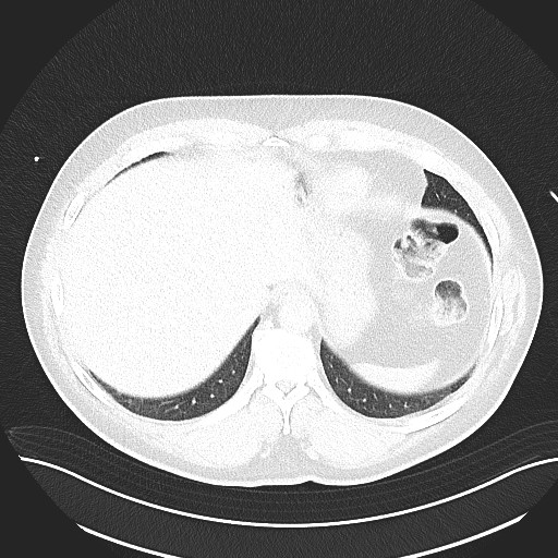 File:Anomalous origin of the left coronary artery with malignant course (Radiopaedia 77842-90126 Axial lung window 29).jpeg