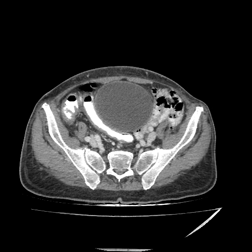 Anorectal carcinoma (Radiopaedia 44413-48064 A 42).jpg