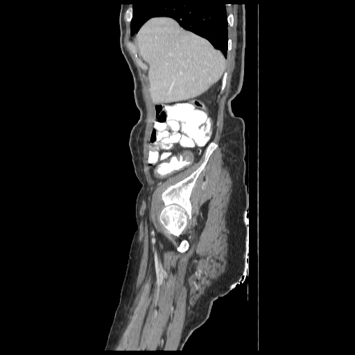 Anorectal carcinoma (Radiopaedia 44413-48064 C 12).jpg