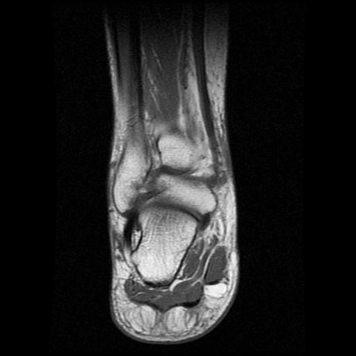 File:Anterior calcaneal process fracture (Radiopaedia 71377-81705 Coronal T1 11).jpg