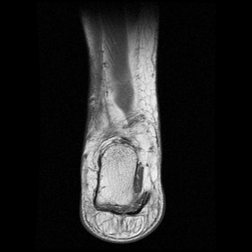 File:Anterior calcaneal process fracture (Radiopaedia 71377-81705 Coronal T1 14).jpg