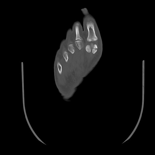 Anterior calcaneal process fracture (Radiopaedia 82590-96762 Axial bone window 42).jpg