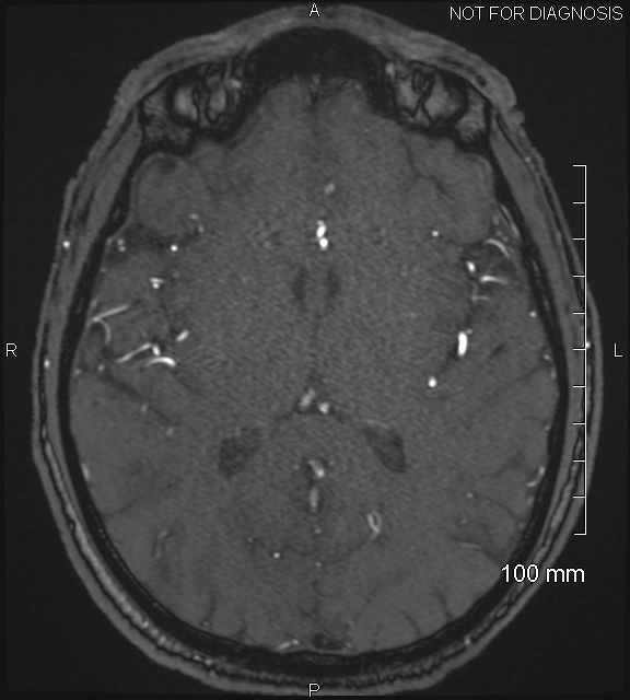 Anterior cerebral artery aneurysm (Radiopaedia 80683-94127 Axial MRA 133).jpg