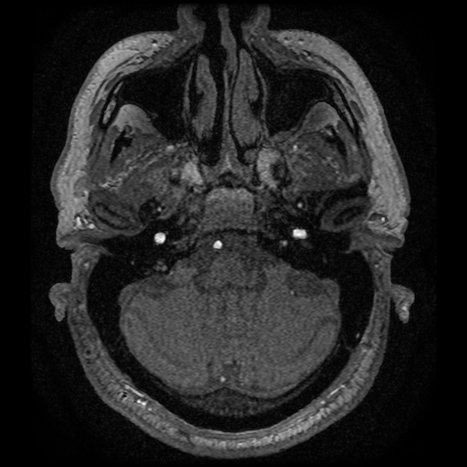 Anterior cerebral artery infarction (Radiopaedia 46794-51323 Axial MRA 14).jpg