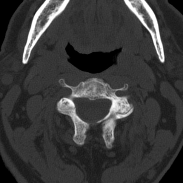 Anterior cervical postdiscectomy arthrodesis (Radiopaedia 32678-33646 Axial bone window 25).jpg