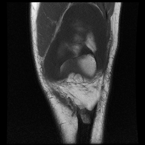 File:Anterior cruciate ligament tear (Radiopaedia 61500-69462 Coronal T1 5).jpg
