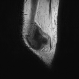 Anterior cruciate ligament tear - pediatric (Radiopaedia 62152-70260 Sagittal PD 19).jpg