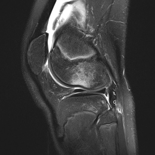 File:Anterior cruciate ligament tear - pediatric (Radiopaedia 62152-70260 Sagittal PD fat sat 27).jpg