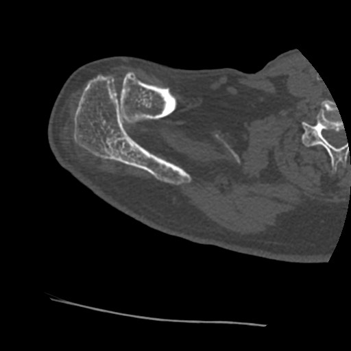 File:Anterior glenohumeral dislocation with Hill-Sachs lesion (Radiopaedia 62877-71249 Axial bone window 13).jpg