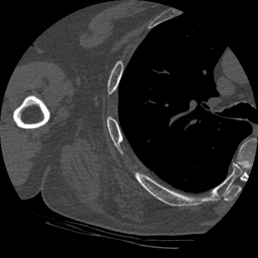 Anterior glenohumeral dislocation with Hill-Sachs lesion (Radiopaedia 62877-71249 Axial bone window 81).jpg