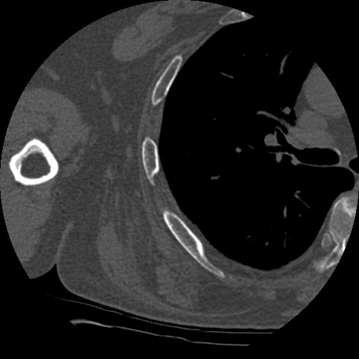 Anterior glenohumeral dislocation with Hill-Sachs lesion (Radiopaedia 62877-71249 Axial bone window 85).jpg