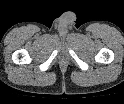 File:Anterior inferior iliac spine avulsion fracture (Radiopaedia 81312-94999 Axial non-contrast 72).jpg